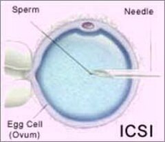 20 ans d’insémination ICSI en Belgique : un suivi des 15.000 enfants serait prudent...
