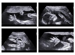 Échographie de plaisir : faut-il légiférer ?