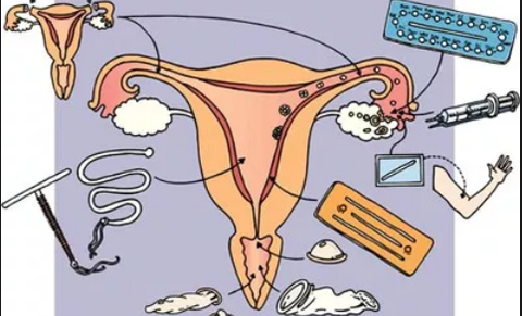 Contraception : résultats belges d’une étude internationale CHOICE