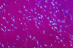 Nieuw spermabank-schandaal Nederland