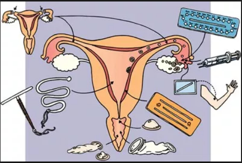 Pays-Bas : imposer la contraception aux femmes jugées incompétentes