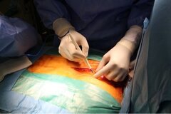 Première naissance issue d'un don d'utérus entre jumelles