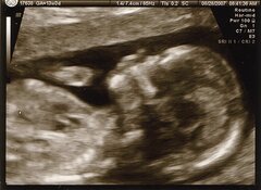 Royaume-Uni : la Haute Cour de justice se penchera sur la loi autorisant l’avortement des bébés handicapés