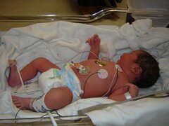 Artificial reproduction: study reveals increased risk of congenital heart defects in children
