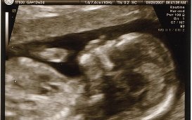 België onder de loep van de VN inzake de rechten van mensen met een handicap: tussen inclusie en het uitsterven van het syndroom van Down