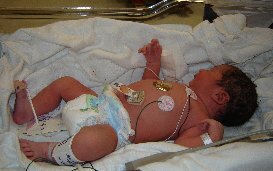 Procréation artificielle : une étude révèle un risque accru de malformations cardiaques congénitales chez les enfants