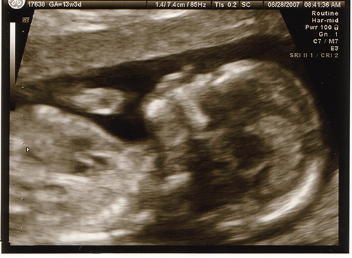 Le fœtus pourrait ressentir la douleur dès la 13ème semaine de grossesse -  Institut Européen de Bioéthique