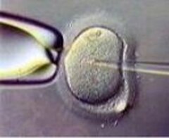 ICSI : Des enfants comme les autres, vraiment ?