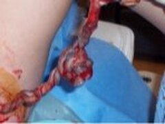 Rapport: potentiel cellules souches du cordon ombilical