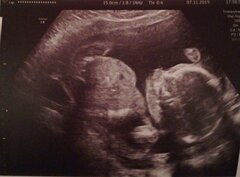 L'avortement tardif au-delà de 12 semaines