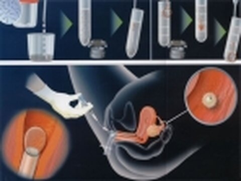 Procréation médicalement assistée (PMA)